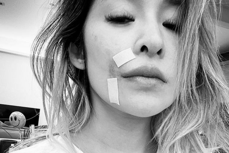 Singer Elva Hsiao still badly scarred five months after dog bite, Entertainment News & Top Stories