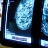 Research that formed Canada’s breast most cancers screening tips ‘flawed,’ researchers say