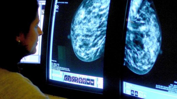 Research that formed Canada’s breast most cancers screening tips ‘flawed,’ researchers say