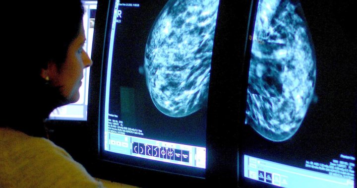 Research that formed Canada’s breast most cancers screening tips ‘flawed,’ researchers say