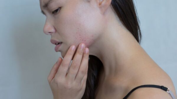The emotional toll of adult acne, Life News & Top Stories