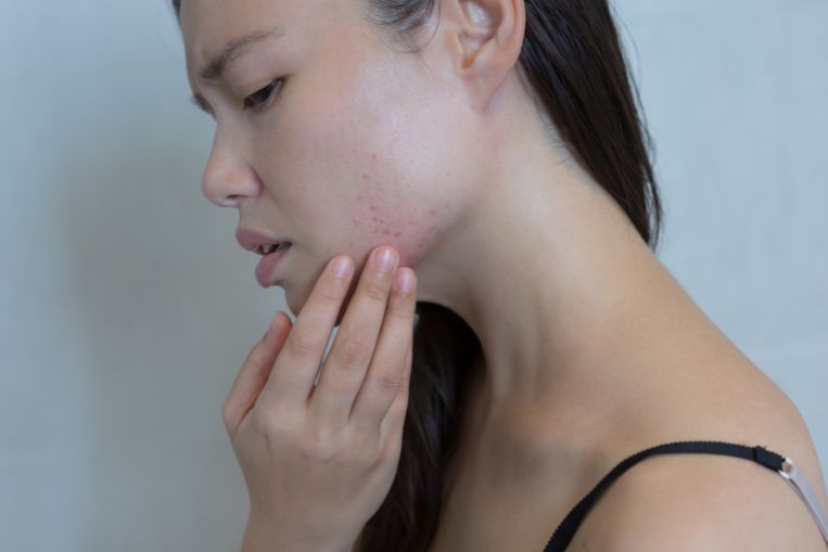 The emotional toll of adult acne, Life News & Top Stories